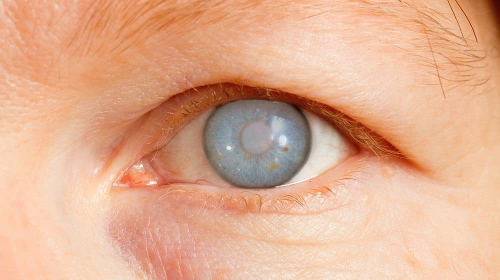 female eye with cataract and glaucoma